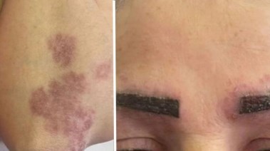 سيدة تواجه مرضاً مناعياً بسبب المايكروبليدنج 