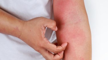 التهاب الجلد