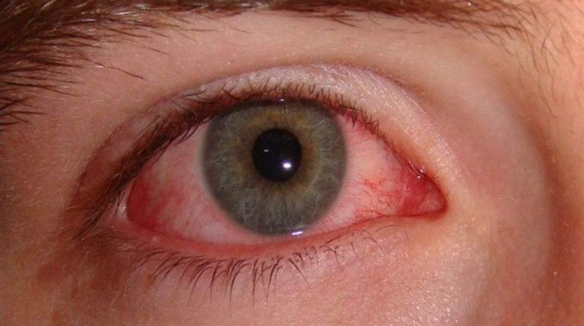 مرض التراكوما 