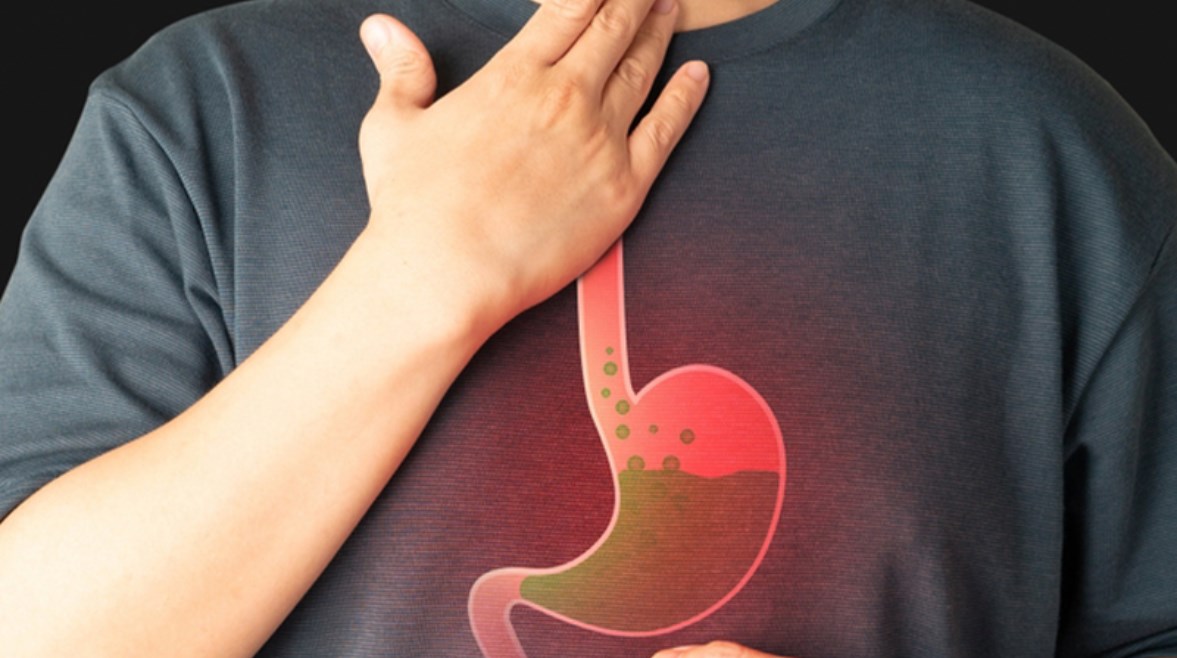 ارتجاع المريء