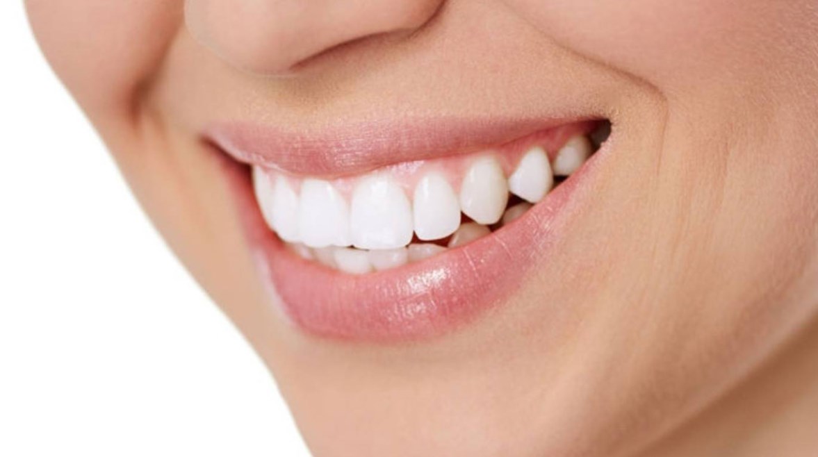 تبييض الأسنان. 