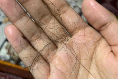 تساقط الشعر ـ أرشيفية
