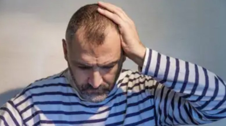 داء الثعلبة 