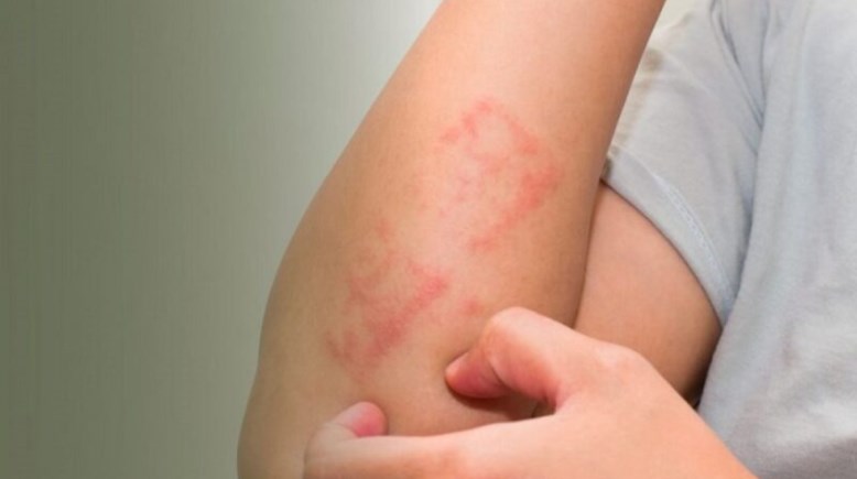 التهاب الجلد 
