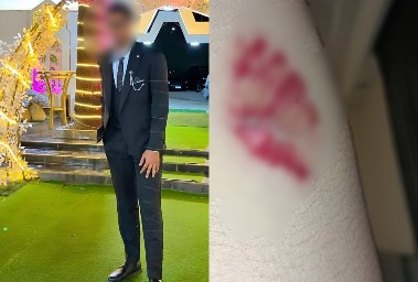 الطبيب ضحية العض