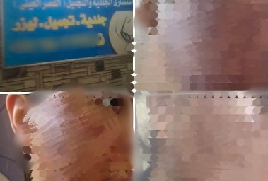 سيدة تتهم عيادة بحرق وجهها 