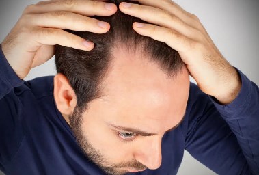 الصلع الوراثي عند الرجال