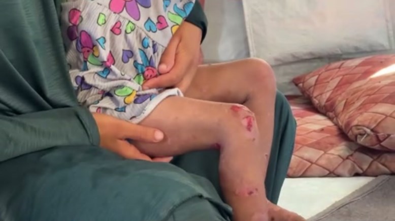 انتشار الأمراض الجلدية بين الأطفال في غزة