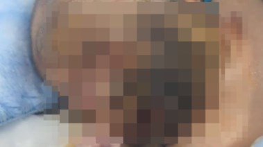 الرضيع المصاب