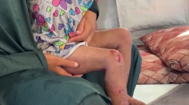 انتشار الأمراض الجلدية بين الأطفال في غزة