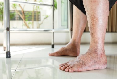 ما هو مرض الأوعية الدموية الطرفية أو PVD؟