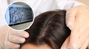لماذا تصبح فروة الشعر دهنية للغاية؟