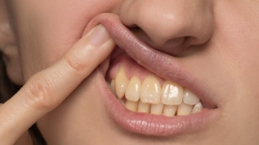اصفرار الأسنان 
