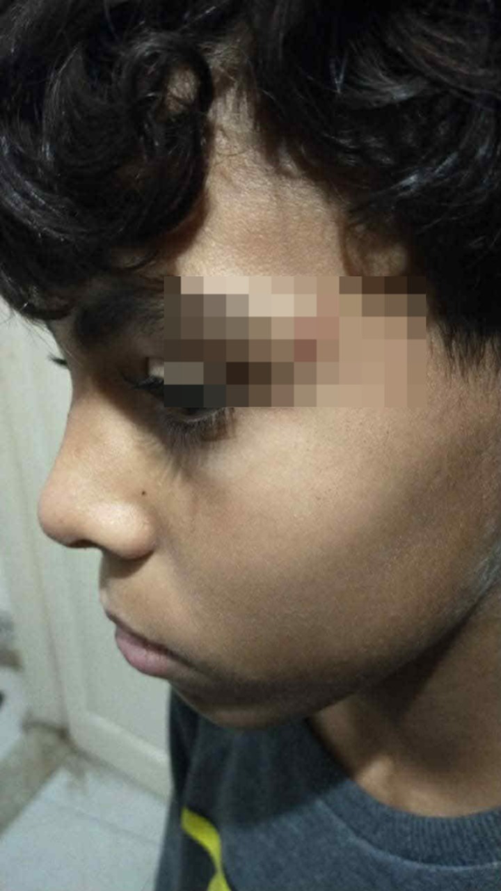 جانب من إصابة الطفل