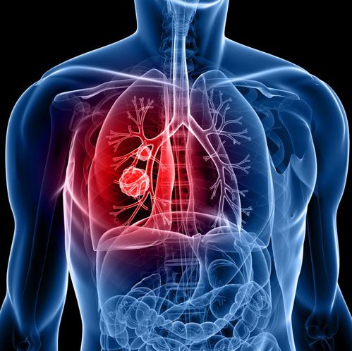 Lung-Cancer