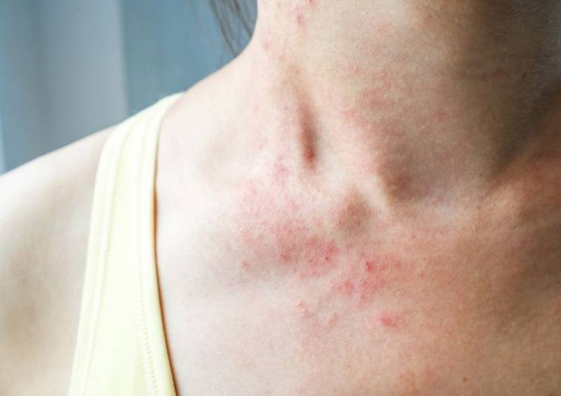 الأكزيما-عند-البالغين