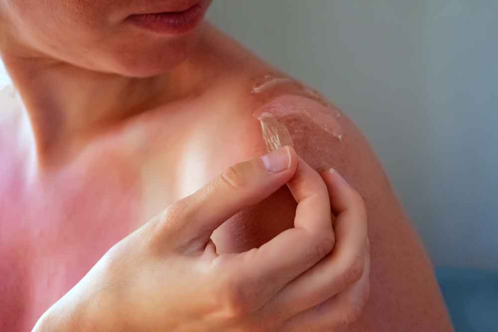 sunburn-effects sunburn-effects