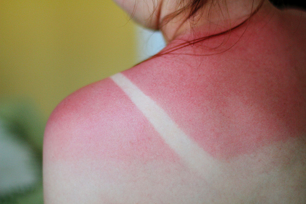 sunburn sunburn