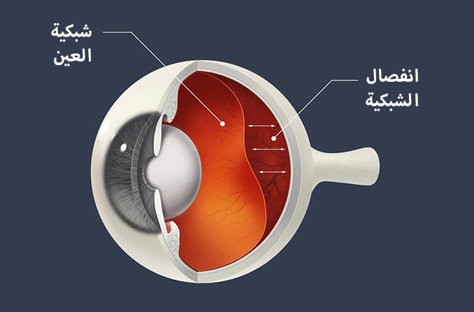 انفصال شبكية العين