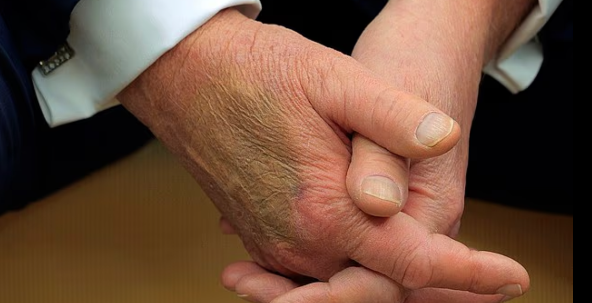 آثار الكدمات على يد ترامب